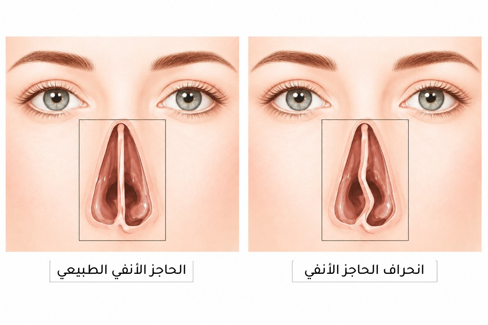 رسم توضيحي يقارن بين الحاجز الأنفي الطبيعي والحاجز الأنفي المنحرف، يوضّح كيف يؤدي الانحراف إلى تضييق أحد جانبي الأنف.