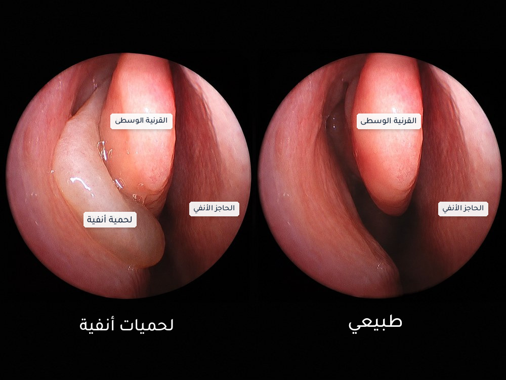 صورة بالمنظار داخل الأنف تقارن بين اللحميات الأنفية وتجويف أنفي طبيعي، مع ظهور القرنية الوسطى والحاجز الأنفي.