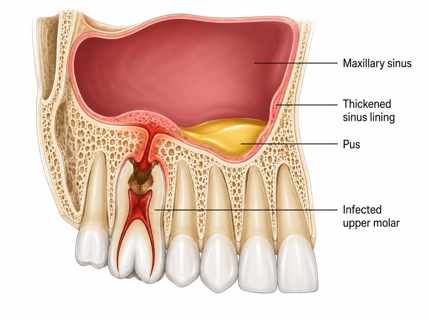 Diagram showing an infected upper molar spreading infection into the maxillary sinus above it, with thickened sinus lining and pus.