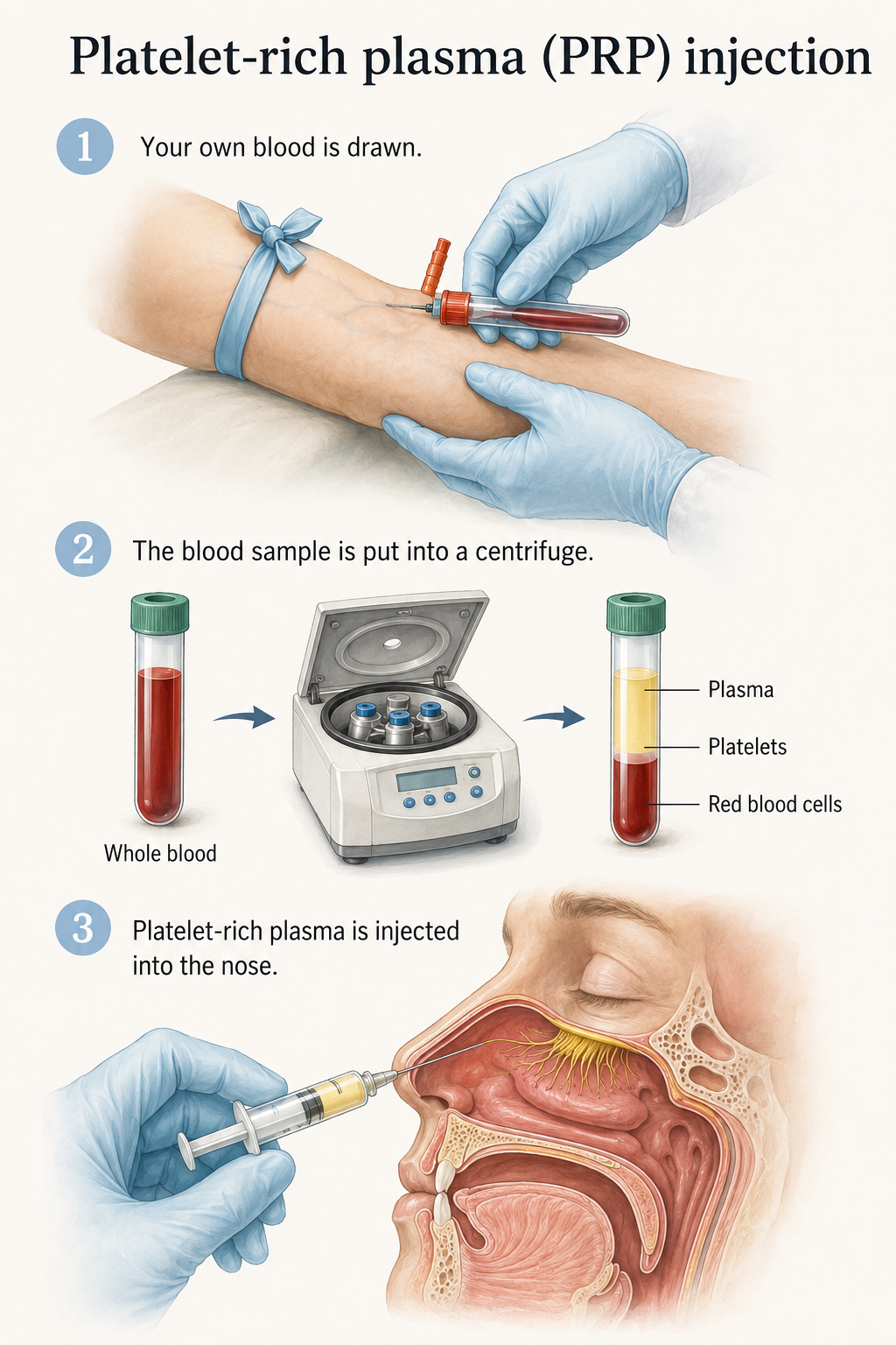 Three-step illustration showing blood collection, centrifugation, and platelet-rich plasma injection into the nose.