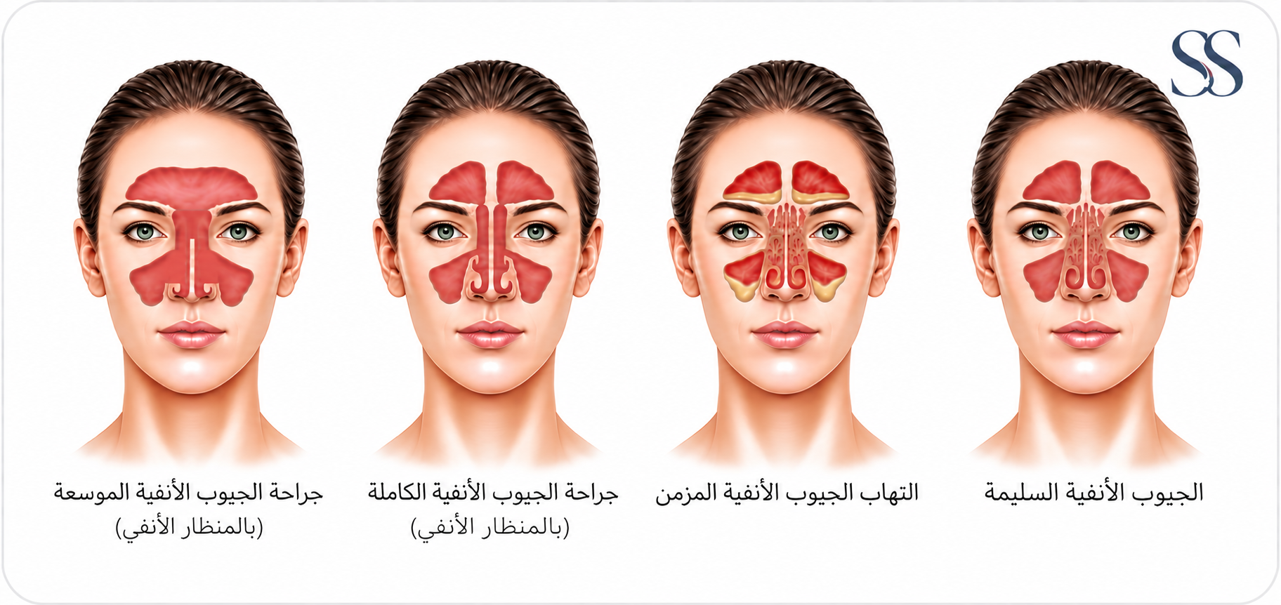 رسم يقارن، من اليمين إلى اليسار، بين الجيوب الأنفية السليمة، والتهاب الجيوب الأنفية المزمن، وجراحة الجيوب الأنفية الكاملة بالمنظار الأنفي، وجراحة الجيوب الأنفية الموسعة بالمنظار الأنفي، موضحًا فتحات جيوب أنفية أكبر تدريجيًا.
